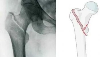 Звуки перелома костей